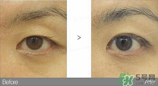 埋線(xiàn)雙眼皮需要拆線(xiàn)嗎？埋線(xiàn)雙眼皮怎么拆線(xiàn)