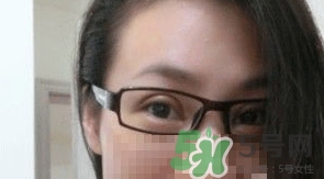 定點(diǎn)雙眼皮恢復(fù)過程圖_定點(diǎn)雙眼皮要多久恢復(fù)