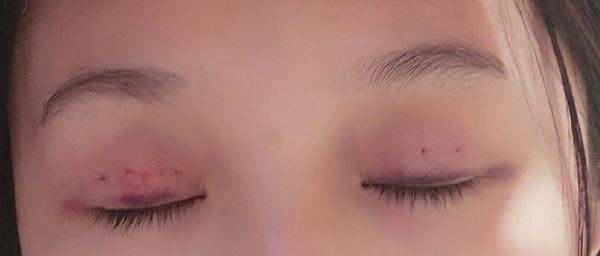 定點(diǎn)雙眼皮恢復(fù)過程圖_定點(diǎn)雙眼皮要多久恢復(fù)