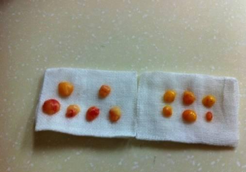 韓式三點雙眼皮是永久嗎？三點雙眼皮能保持多久？