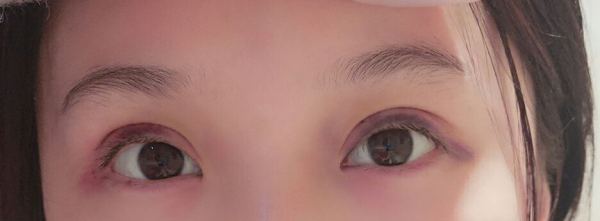 定點(diǎn)雙眼皮恢復(fù)過程圖_定點(diǎn)雙眼皮要多久恢復(fù)