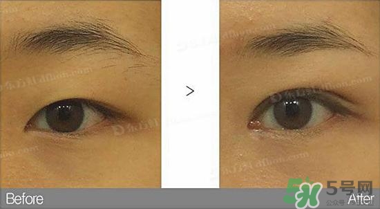 埋線(xiàn)雙眼皮需要拆線(xiàn)嗎？埋線(xiàn)雙眼皮怎么拆線(xiàn)