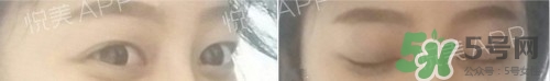 埋線雙眼皮多久恢復(fù)自然？埋線雙眼皮多久能恢復(fù)