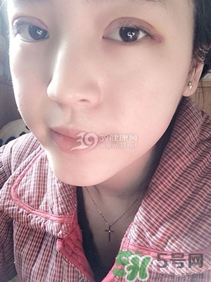 什么是定點雙眼皮？定點雙眼皮多少錢？