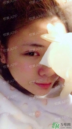 定點(diǎn)雙眼皮恢復(fù)過(guò)程圖_定點(diǎn)雙眼皮要多久恢復(fù)