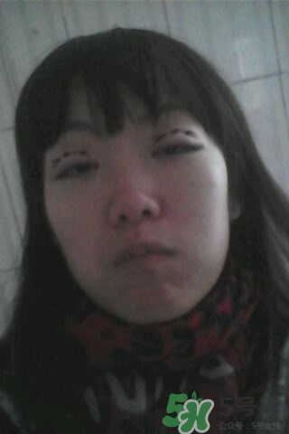 什么是定點雙眼皮？定點雙眼皮多少錢？