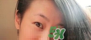 定點(diǎn)雙眼皮恢復(fù)過程圖_定點(diǎn)雙眼皮要多久恢復(fù)