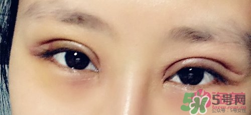 切開雙眼皮多久消腫？切開雙眼皮多久恢復？