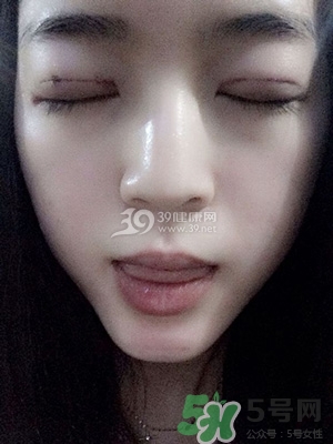 什么是定點雙眼皮？定點雙眼皮多少錢？