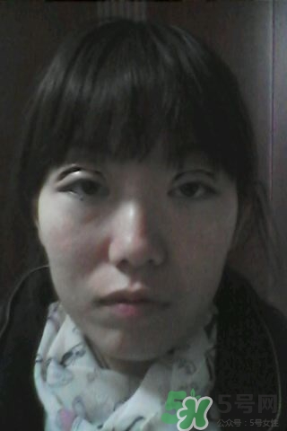 什么是定點雙眼皮？定點雙眼皮多少錢？