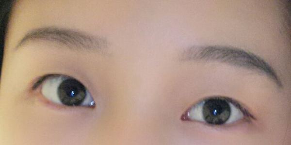 定點(diǎn)雙眼皮恢復(fù)過程圖_定點(diǎn)雙眼皮要多久恢復(fù)