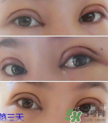 定點(diǎn)雙眼皮恢復(fù)過程圖_定點(diǎn)雙眼皮要多久恢復(fù)