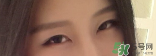 切開雙眼皮多久消腫？切開雙眼皮多久恢復？