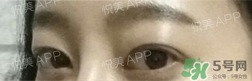 埋線雙眼皮多久恢復(fù)自然？埋線雙眼皮多久能恢復(fù)
