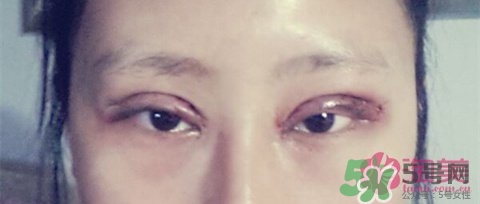 切開雙眼皮多久消腫？切開雙眼皮多久恢復？