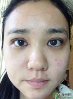 埋線雙眼皮的危害_埋線雙眼皮有風險后遺癥嗎