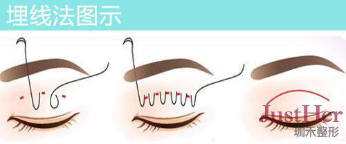 定點(diǎn)雙眼皮怎么做？定點(diǎn)雙眼皮需要拆線嗎？