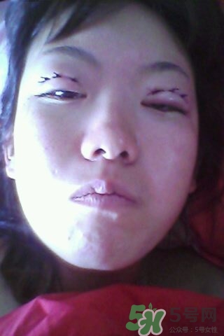 什么是定點雙眼皮？定點雙眼皮多少錢？