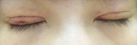 韓式三點雙眼皮是永久嗎？三點雙眼皮能保持多久？