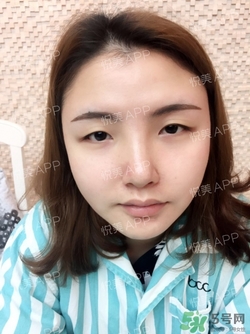 定點(diǎn)雙眼皮恢復(fù)過(guò)程圖_定點(diǎn)雙眼皮要多久恢復(fù)
