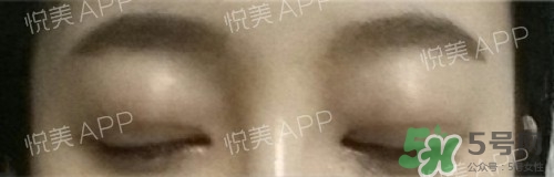 埋線雙眼皮多久恢復(fù)自然？埋線雙眼皮多久能恢復(fù)