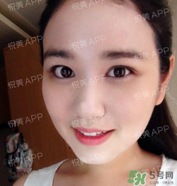 埋線雙眼皮的危害_埋線雙眼皮有風險后遺癥嗎