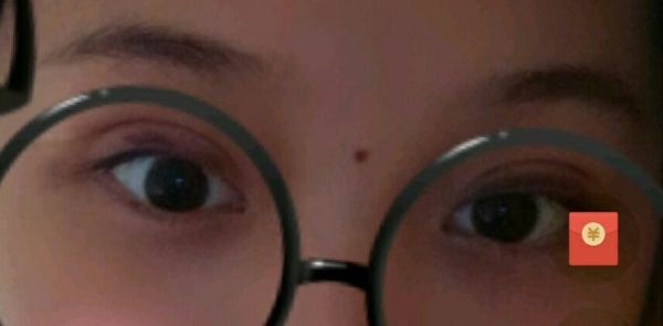 定點(diǎn)雙眼皮恢復(fù)過程圖_定點(diǎn)雙眼皮要多久恢復(fù)