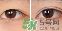 定點(diǎn)雙眼皮恢復(fù)過程圖_定點(diǎn)雙眼皮要多久恢復(fù)