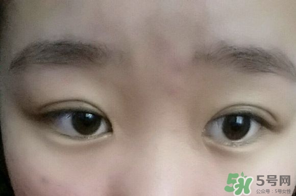 埋線(xiàn)雙眼皮需要拆線(xiàn)嗎？埋線(xiàn)雙眼皮怎么拆線(xiàn)
