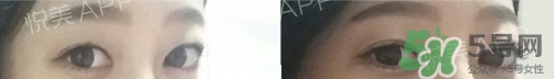 埋線雙眼皮多久恢復(fù)自然？埋線雙眼皮多久能恢復(fù)