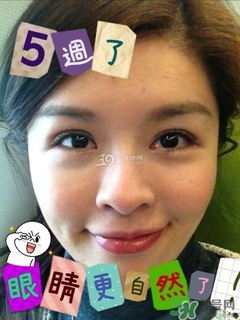 重瞼術(shù)是什么？重瞼術(shù)是永久的嗎？