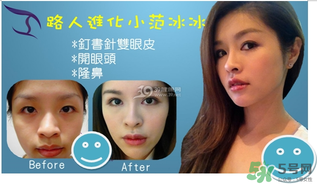 重瞼術(shù)是什么？重瞼術(shù)是永久的嗎？