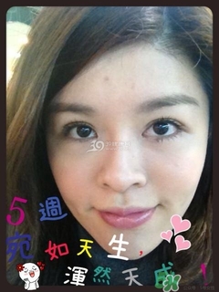 重瞼術(shù)是什么？重瞼術(shù)是永久的嗎？