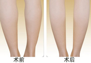 小腿吸脂多久見效？小腿吸脂后多久能看見效果？