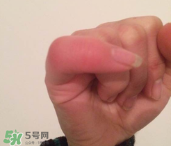 小拇指凍腫了怎么辦？為什么小拇指容易凍？