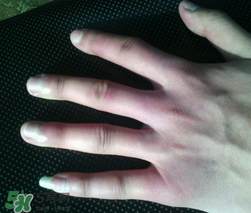 小拇指凍腫了怎么辦？為什么小拇指容易凍？