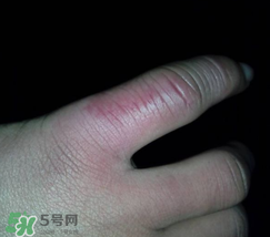 小拇指凍腫了怎么辦？為什么小拇指容易凍？