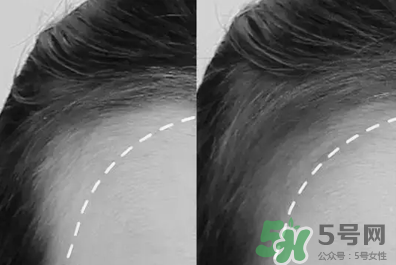 發(fā)際線高適合什么發(fā)型？發(fā)際線高怎么辦