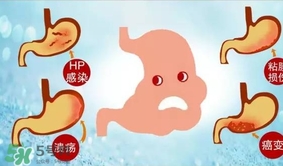 神經(jīng)性胃痙攣是什么？神經(jīng)性胃痙攣是什么原因？