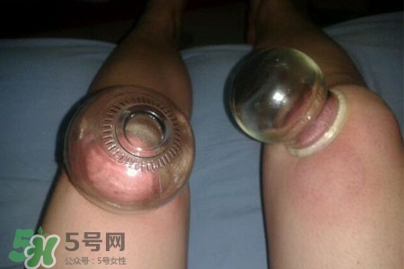 拔罐瘦腿真的有效嗎？腿部拔火罐減肥效果好嗎？