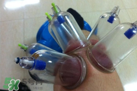 小腿能拔罐嗎？在小腿上拔火罐有什么作用？