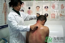 刮痧可以減肥嗎？刮痧減肥有效果嗎？