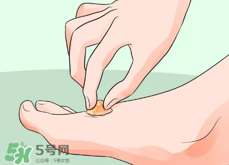 水泡怎么處理？水泡要不要刺破？