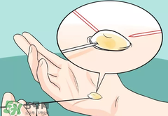 水泡怎么處理？水泡要不要刺破？