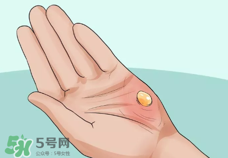 水泡怎么處理？水泡要不要刺破？