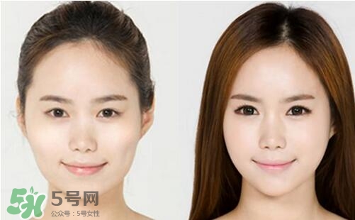 瘦臉針分為幾種類型？瘦臉針有哪幾個牌子？