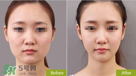 瘦臉針分為幾種類型？瘦臉針有哪幾個牌子？