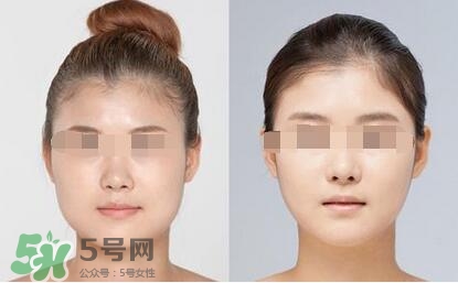 瘦臉針分為幾種類型？瘦臉針有哪幾個牌子？