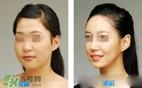 瘦臉針分為幾種類型？瘦臉針有哪幾個牌子？