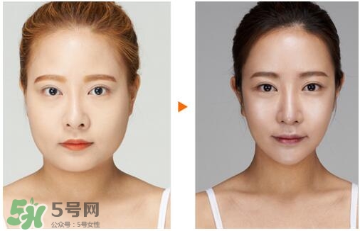 瘦臉針分為幾種類型？瘦臉針有哪幾個牌子？